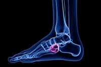 Who Is Prone to Developing Cuboid Syndrome?