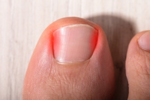 Pain Around the Toenails