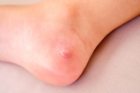 Understanding a Diabetic Foot Blister