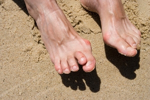 Identifying Hammertoe and Its Causes