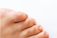 How to Treat and Prevent Foot Corns