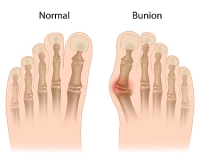 Causes and Treatment Options for Bunions