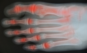 Recognizing Early Signs of Foot Arthritis