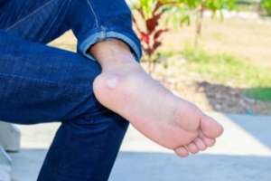How to Treat Stubborn Plantar Warts