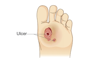 Ways Diabetes Affects the Feet